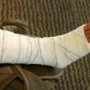Турист на Ай-Петри сломал ногу