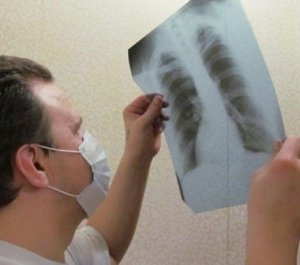 Заболеваемость туберкулезом в Феодосии снизилась на треть