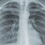 Медики зафиксировали снижение заболеваемости туберкулезом в Крыму