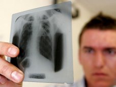 В Крыму снизилась заболеваемость туберкулёзом
