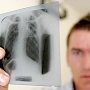 За последние 2 года заболеваемость туберкулёзом в Крыму снизилась почти на 6,5%, — эксперт