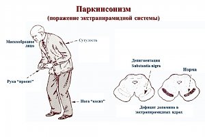 Как реабилитировать человека с заболеванием «имени» Паркинсона