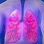 Обширное поражение лёгких при пневмонии не означает, что пациент обречён, — пульмонолог